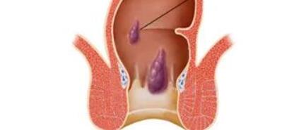 肛门口有个肉球突出是怎么回事（肛门口有个肉球突出的原因）
