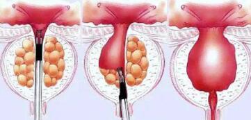 前列腺增生的最佳治疗方法