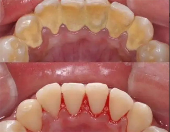 洗牙后出现的牙缝能恢复吗
