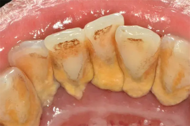 洗牙后出现的牙缝能恢复吗