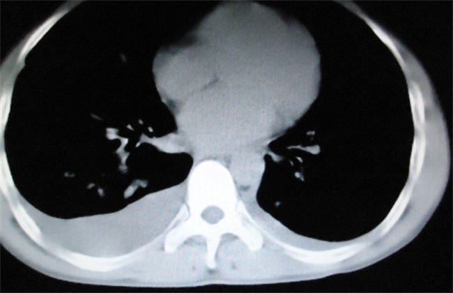 什么情况下需要检查肺ct