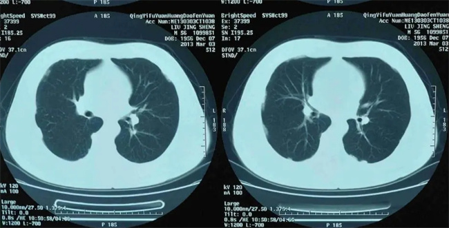 什么情况下需要检查肺ct