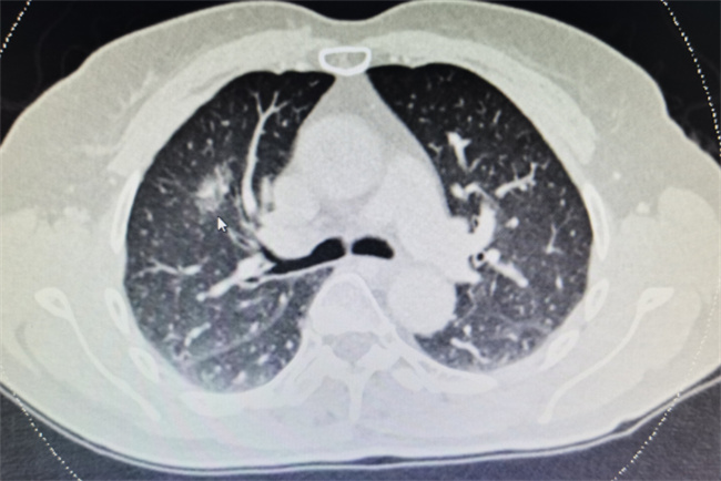 什么情况下需要检查肺ct